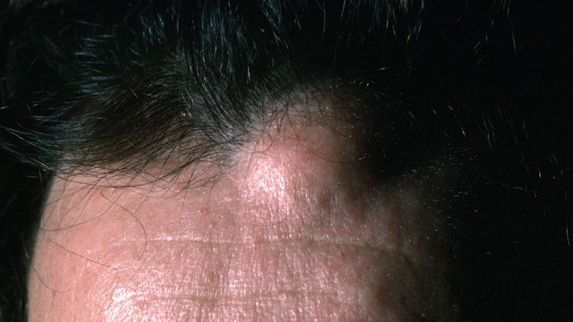 Poți scăpa de lipom fără intervenție chirurgicală cu un tratament naturist rapid