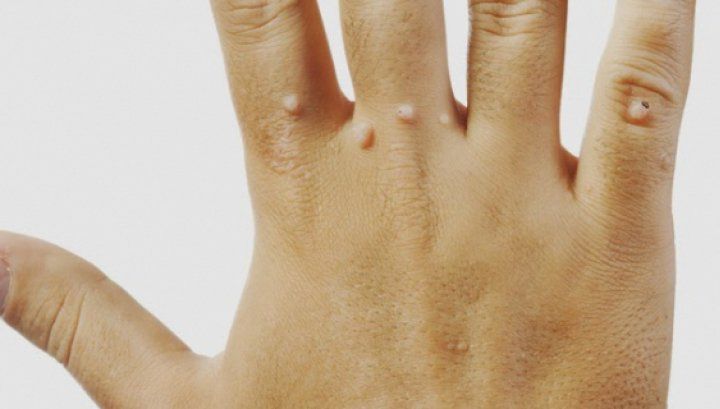 Cum scapi de negi într-un mod foarte simplu