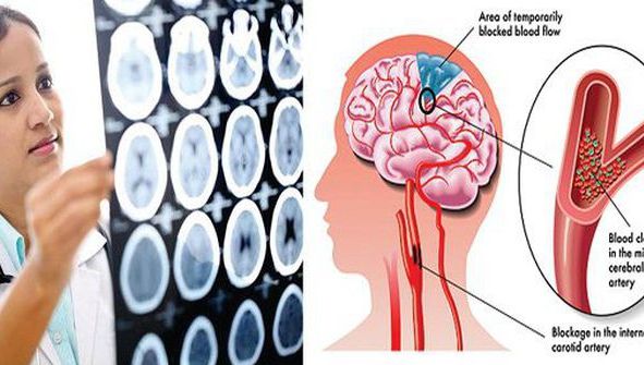 Semne care îţi spun că durerea de cap pe care o ai poate fi fatală
