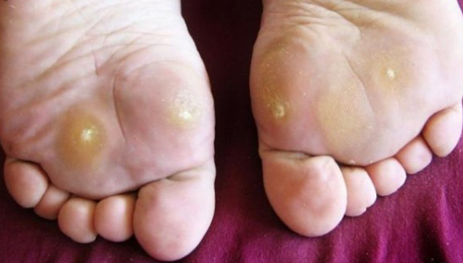 Ţi-a apărut aşa ceva pe talpă? Iată cum poţi scăpa de ele fără să provoci o infecţie