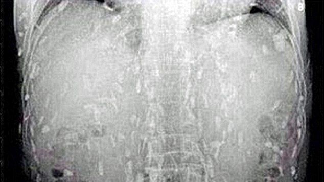 S-a dus la spital acuzând o durere de stomac. Medicii au rămas ȘOCAȚI când au descoperit ce avea