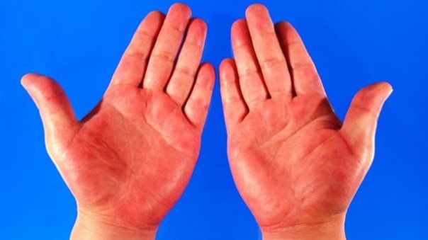 Medicii trag un semn de alarmă. Aceste boli ascunse se văd prima dată pe pielea ta 