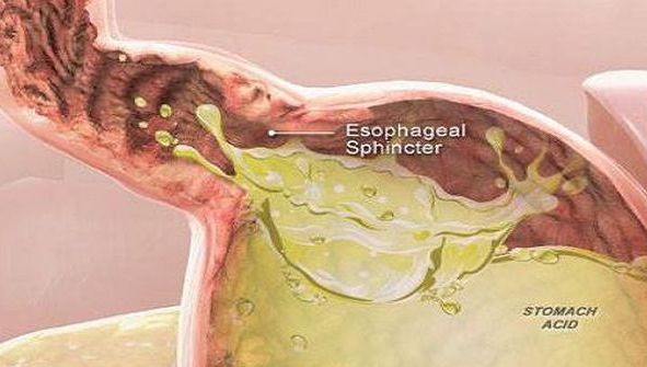 Acest tip de cancer se dezvoltă rapid şi se confundă cu refluxul acid.Îl poţi avea fără să bănuieşti
