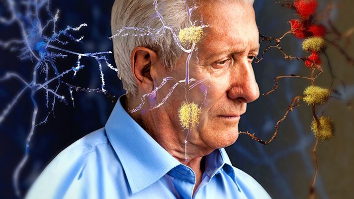 Persoanele cu această grupă de sânge sunt ferite de Alzheimer