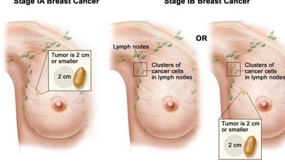 Ziua luptei împotriva cancerului la sân. Statistici: 3000 de românce, diagnsticate în fiecare an