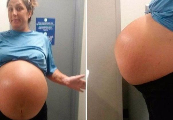 A rămas însărcinată, dar burta era prea mare. În sala de operație, medicii au înghețat 