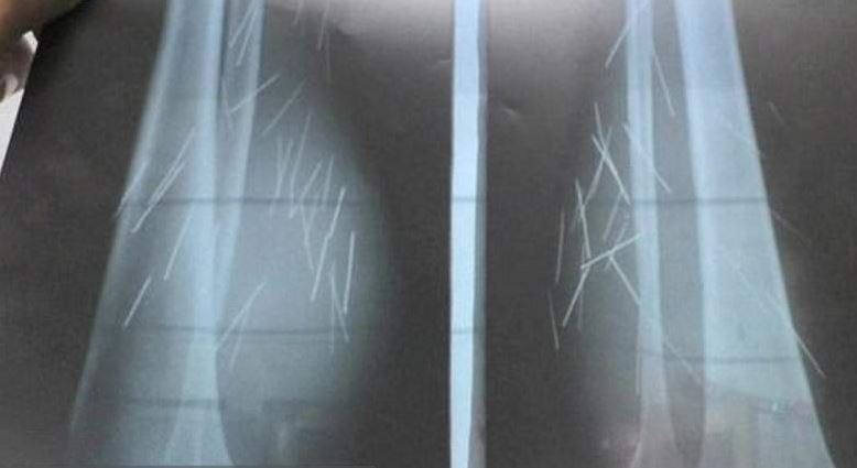 Femeia cu 70 de tipuri de ace în picioare. Nu are habar cum au ajuns acolo