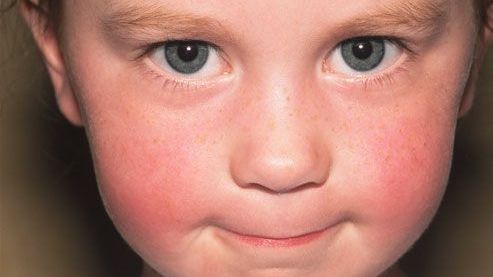 Scarlatina, simptome și tratament. Cum o recunoști?