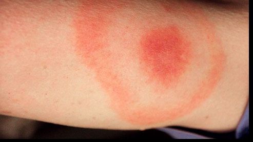 A început sezonul căpușelor! Uite care sunt primele semne că ai fost mușcat 