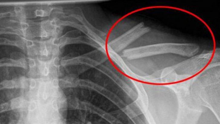 Otrava asta îţi distruge oasele, însă o bei în fiecare zi! Sigur nu ştiai asta!