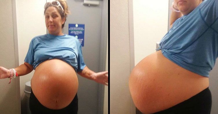 Avea o burtă de gravidă imensă. Când a născut, doctorii au rămas şocaţi de copil