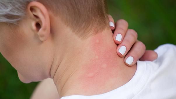 Cum tratezi rapid înțepăturile de insecte