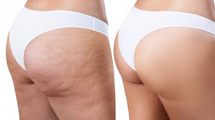 Remediul ţinut secret. Cum scapi de celulită rapid şi fără efort 
