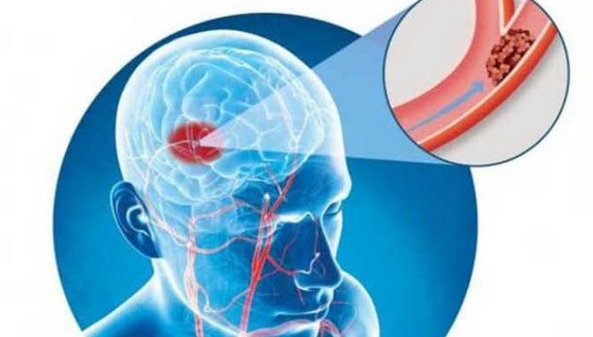 Accidentul vascular cerebral ischemic este cel mai frecvent