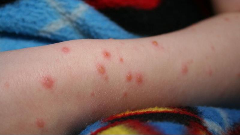 ALERTĂ: peste 100 de cazuri noi de rujeolă au fost depistate în ultimele zece zile în România