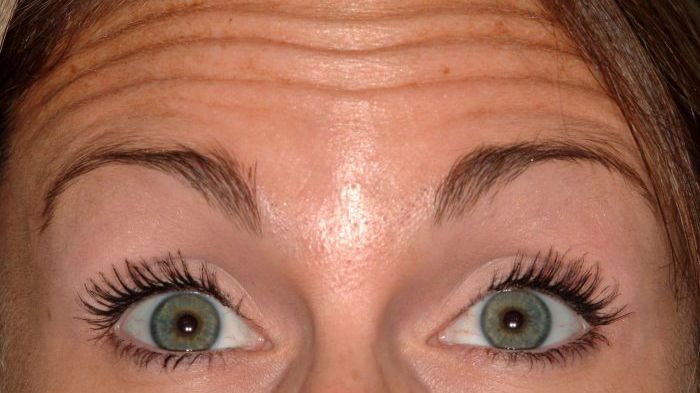 Ridurile de pe frunte pot trăda un risc ridicat al unei afecţiuni grave. Părerea cercetătorilor 