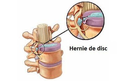 Hernie de disc. Primele simptome ale afecţiuni de care suferă Simona Halep