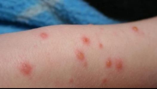 RUJEOLA, amenințare iminentă, urmează 12-24 de luni foarte dificile. Alertă sanitară globală