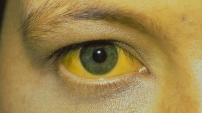 Cum se transmite hepatita A? Simptome