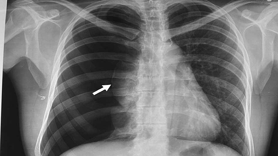 Ce este pneumotoraxul?