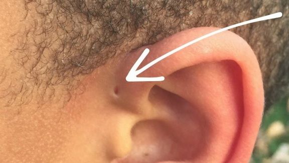 Misterul oamenilor care se nasc cu o gaură pe ureche. Semnul care bulversează lumea ştiinţifică