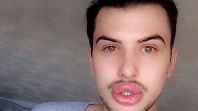 A vrut să fie perfect, dar cum și-a modificat corpul a șocat: până și buzele i-au explodat