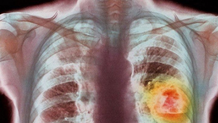 Dacă ai aceste simptome, multă grijă: ar putea fi cancer pulmonar