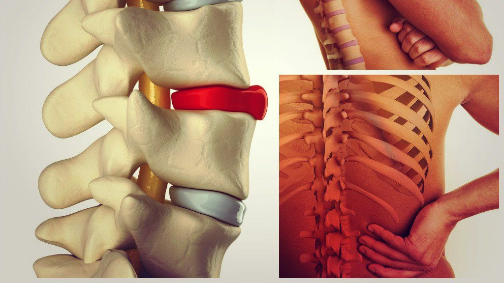 Ce este hernia de disc? Simptome, cauze și tratament 