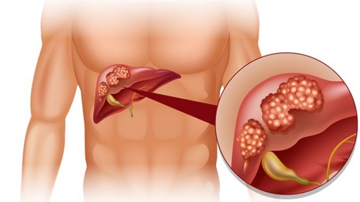 Primele simptome ale cancerului de ficat pe care mulţi le ignoră