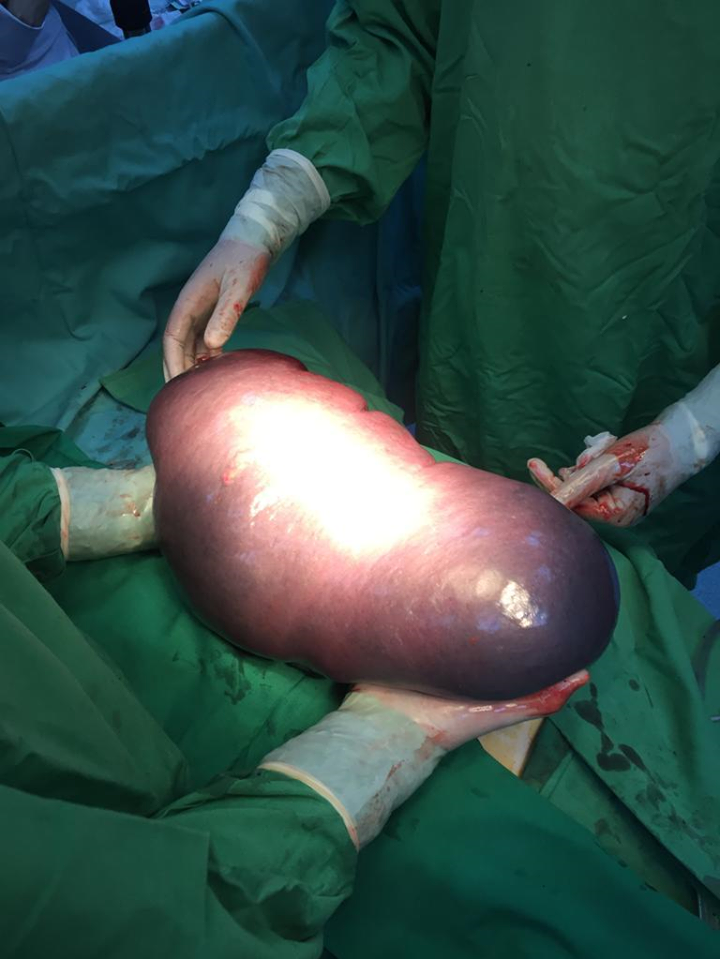 Medicii au decis să îi scoată splina. În timpul operației au avut un ȘOC. Are peste 6 kg!