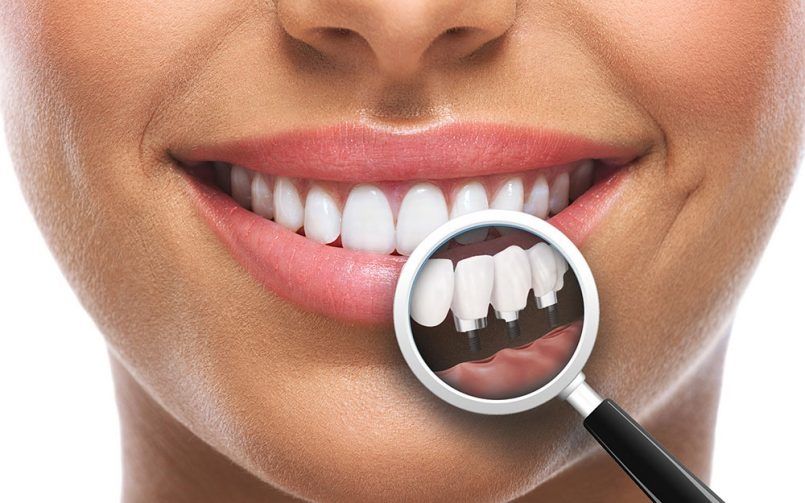 Nu întotdeauna este recomandat implantul dentar