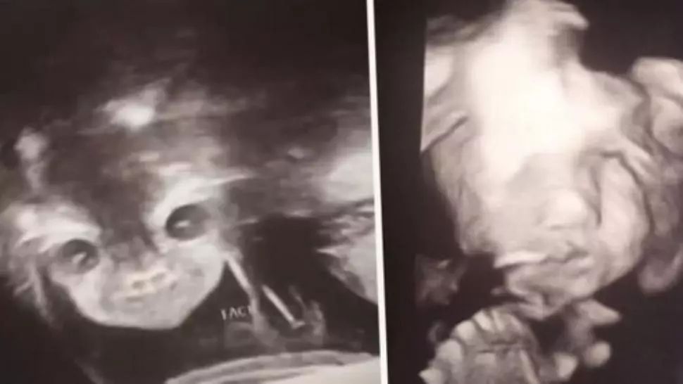 La ecografie, a primit șocul: "E copilul diavolului! Mi se uită direct în suflet!" Ce purta în pântec