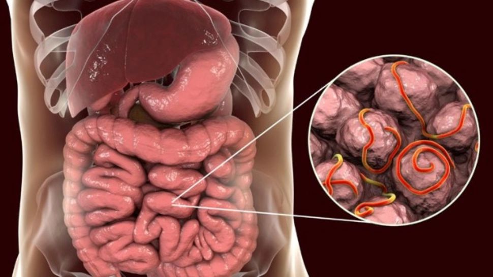 Totul despre praziți intestinali - Simptome, cauze și tratament