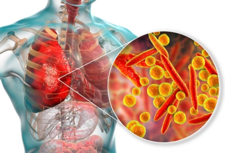 Semnal de alarmă îngrijorător: aproape 10.000 de cazuri de tuberculoză în România, în 2023. Poluarea aerului crește riscul de îmbolnăvire
