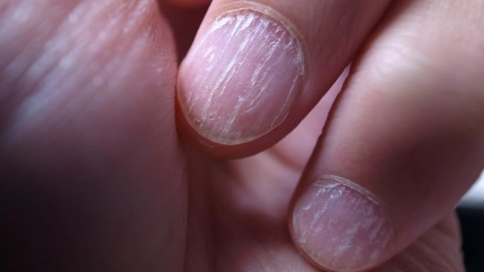 Cand devin unghiile fragile. Afectiuni care se ascund in spatele acestui simptom