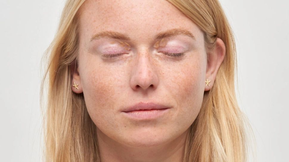 Semne la ochi sau la mâini care  trădează nivelul de colesterol crescut în sânge