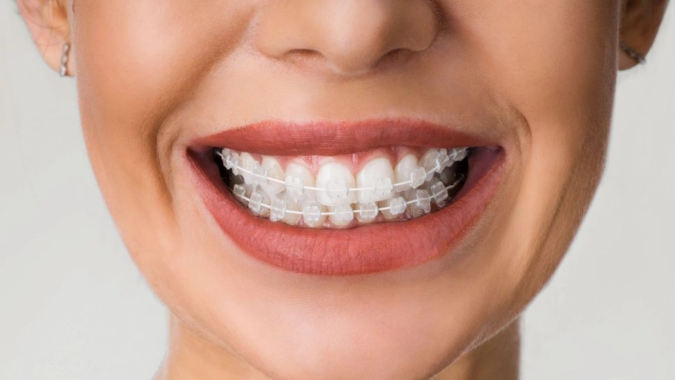 Zâmbetul care strălucește: De ce să alegi un aparat dentar safir pentru corecția danturii (P)