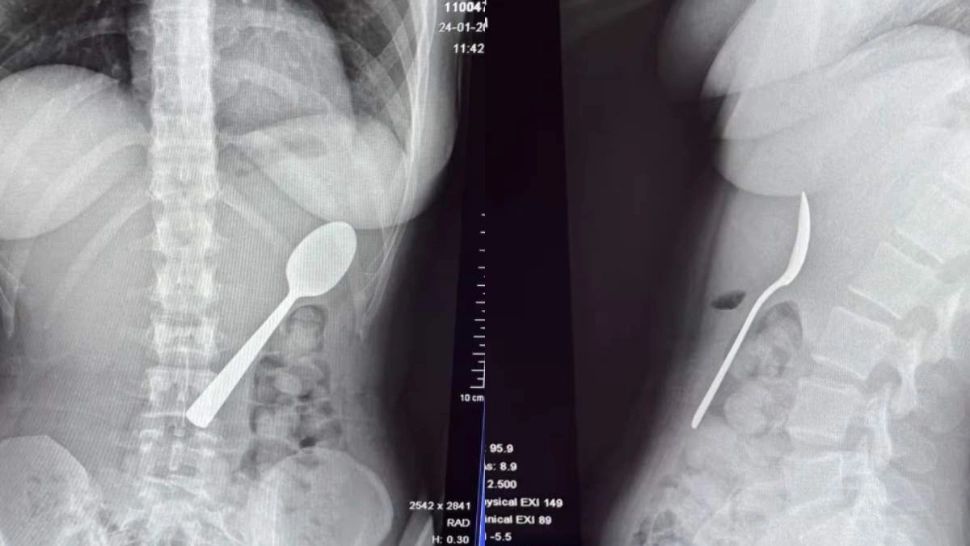 Incident neobișnuit: o femeie a înghițit o lingură de 17 cm în timp ce mânca iaurt
