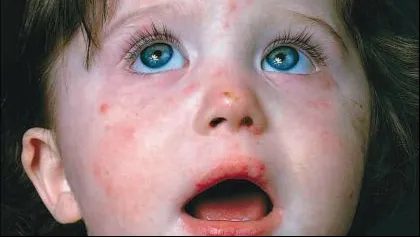 Focar de rujeolă în Arad. Sunt confirmate cinci cazuri la copii care nu au fost vaccinaţi