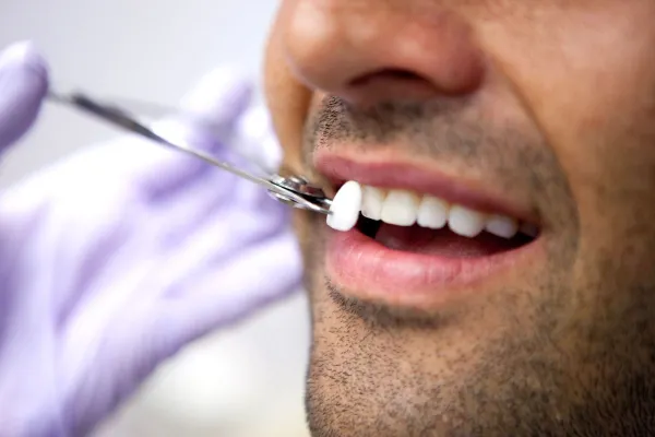 SĂNĂTATE. Secretul din spatele zambetului de vedete – Fațetele dentare