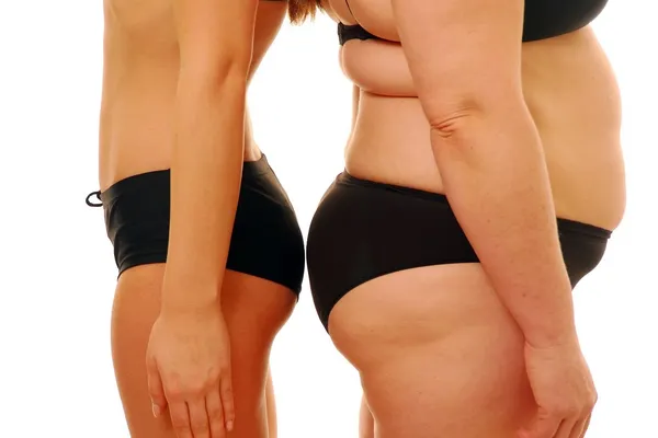 SĂNĂTATE. Plusurile şi minusurile abdominoplastiei