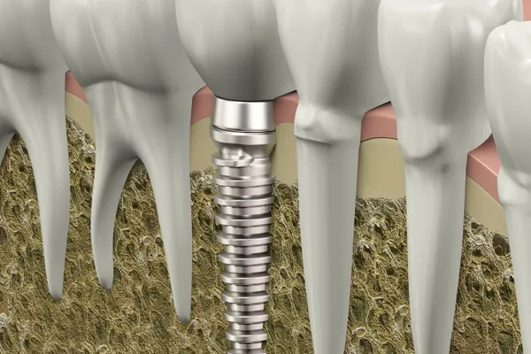SĂNĂTATE. 5 mituri despre implantul dentar