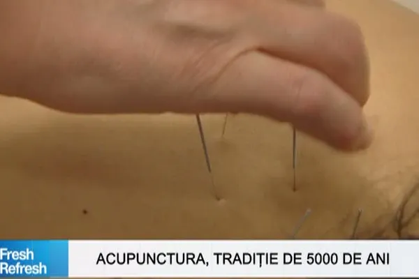 Fresh Refresh. Acupunctura, tradiţie veche de 5000 de ani