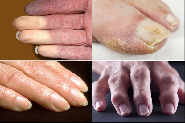 12 probleme de sănătate pe care ți le dezvăluie mâiniile și unghiile. Cum le identifici