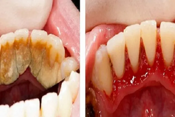 Cum scapi de tartru cu 3 alimente banale. Dentiștii ți-au ascuns mereu asta!