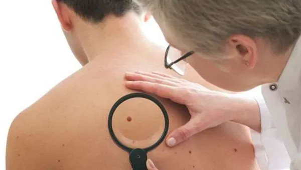 Ai multe aluniţe pe corp? Cât de mult îţi influenţează sănătatea apariţia acestora