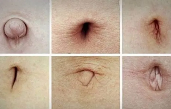 Ce spune forma buricului despre sănătatea ta. Ar trebui să consulţi un medic urgent dacă îl ai aşa