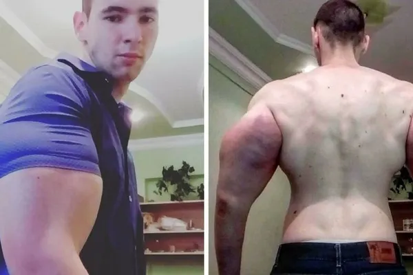 Rusia uimeşte iar! A dat lumii un "Popeye" real. Şi-a injectat chimicale, acum e aproape de moarte