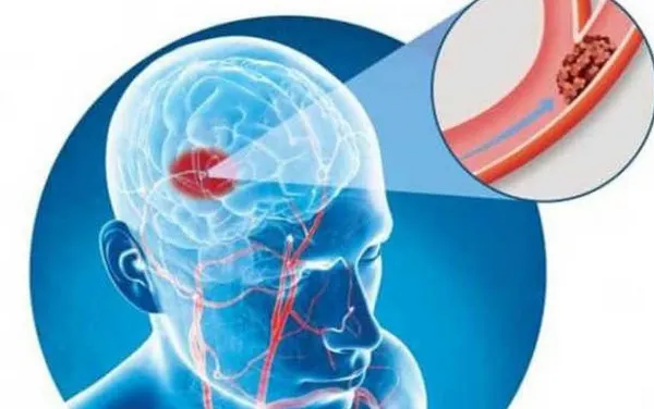 5 semne care îţi spun că faci accident vascular cerebral