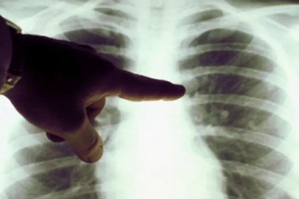 Veste bună pentru bonavii de TBC: legea tuberculozei a trecut de Comisia de Sănătate. Ce prevede